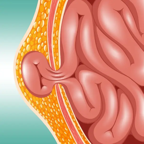 Hernia of the Abdomen and Groin (Nurses, CCM, CRC, NASW, and WC CA approved) – 2.5 CE/Contact Hours