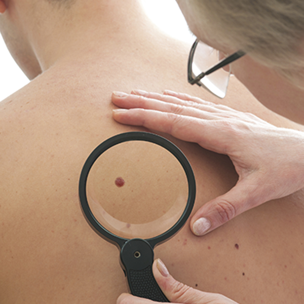Skin Cancer: Melanoma (Nurses, CCM, CRC, and WC CA approved) – 1.0 CE/Contact Hour