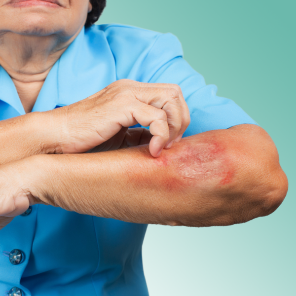 Skin Infections in Long Term Care Facilities (NAB/NCERS Approved) – 1.75 CE/Contact Hours